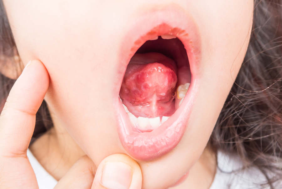 6 contagious diseases in young children Know quickly Treat quickly
